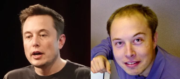 elon-musk-hair-transplant