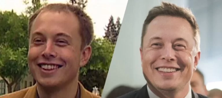 elon-musk-hair-transplant-2
