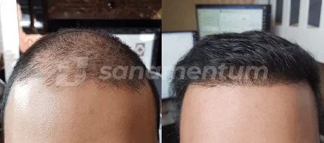 https://sanamentum.com/public/photos/shares/hair-transplant-before-after-1