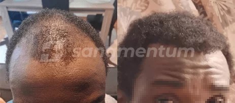 https://sanamentum.com/public/photos/shares/hair-transplant-before-after-10