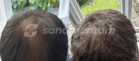 https://sanamentum.com/public/photos/shares/hair-transplant-before-after-13