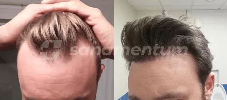 https://sanamentum.com/public/photos/shares/hair-transplant-before-after-14