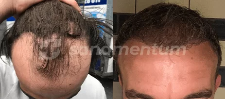 https://sanamentum.com/public/photos/shares/hair-transplant-before-after-15