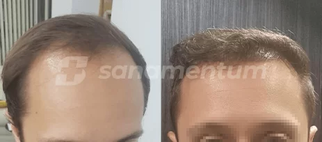 https://sanamentum.com/public/photos/shares/hair-transplant-before-after-17