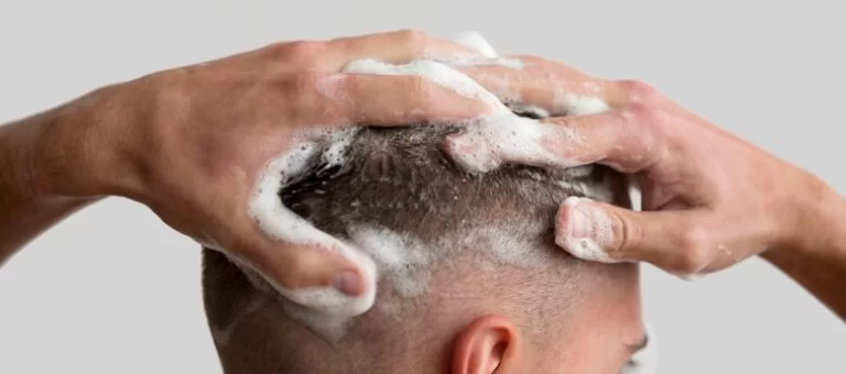 hair-transplant
